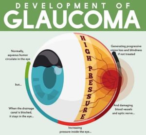 Dog Glaucoma